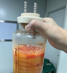 常州水动力吸脂手术要做多久？